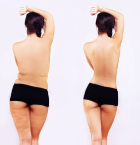 Body Contouring in Daytona Beach, FL